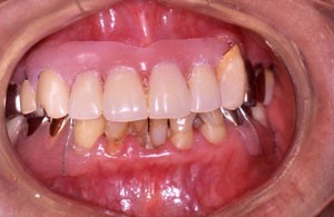 フレキサイト２