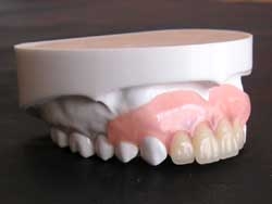 入れ歯2