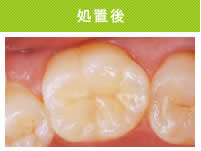 奥歯処置後.jpg